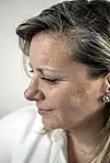 Ana Jelinić prve je hiperpigmentacije primijetila prije desetak godina