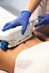 CoolSculpting je neinvazivna metoda kriolipolize kojom se masne stanice selektivno zamrzavaju i postupno eliminiraju iz organizma