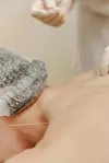 akupunktura