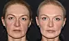 Alenka Trokter oduševljena je novim izgledom. Makeover se sastojao od: korekcije gornjih kapaka ili gornje blefaroplastike, 4 ml Neauvia dermalnog filera za srednji i donji dio lica, 50 jedinica botoxa, botulinskog toksina i LF HYDRO tretmana za lice + tretmana Hydro Delux.