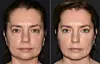 Sandra Kovač izgleda godinama mlađe nakon makeovera kojim joj su joj korigirani donji kapci, lice je zategnuto i osvježeno tretmanima Neauvia dermalnim filerima i botoxom.
