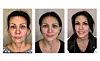 Žena od 54 godine koja je naglo smršavjela, osam dana nakon operacije i tri mjesec a nakon što je dr. Glumičić obavio zahvat