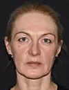 Gospođa Alenka Trokter prije zahvata u poliklinici Lohius Filipović Medical Group.