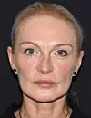 Gospođa Alenka Trokter u poliklinici Lohius Filipović Medical Group odradila je makeover koji se sastojao od korekcije gornjih kapaka ili gornje blefaroplastike, 4 ml Neauvia dermalnog filera za srednji i donji dio lica, 50 jedinica botoxa, botulinskog toksina, LF HYDRO tretman za lice te tretman Hydro Delux.