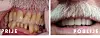 Primjer iz prakse dental centra mimica prije i poslije zahvata.
