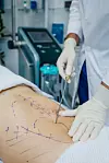 Body-Jet liposukcija koristi mlaz vode pod visokim pritiskom kako bi razgradila i izvukla višak masnog tkiva